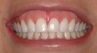 Instead of risking enamel damage, Dr. Morgan had her patient brush with Opalescence Whitening Toothpaste to remove the remaining charcoal and plaque indicator, with sparkling results!
