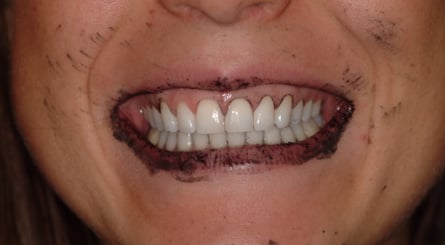 After brushing with activated charcoal and rinsing, difficult to remove charcoal residue is left in the patient’s gingival margins and teeth.