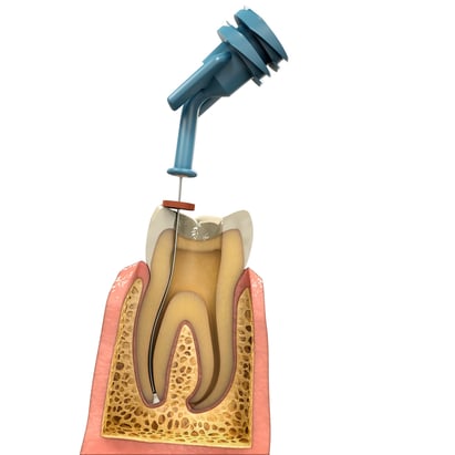 MTAFlow White repair cement being delivered with a NaviTip™ tip following a root canal.