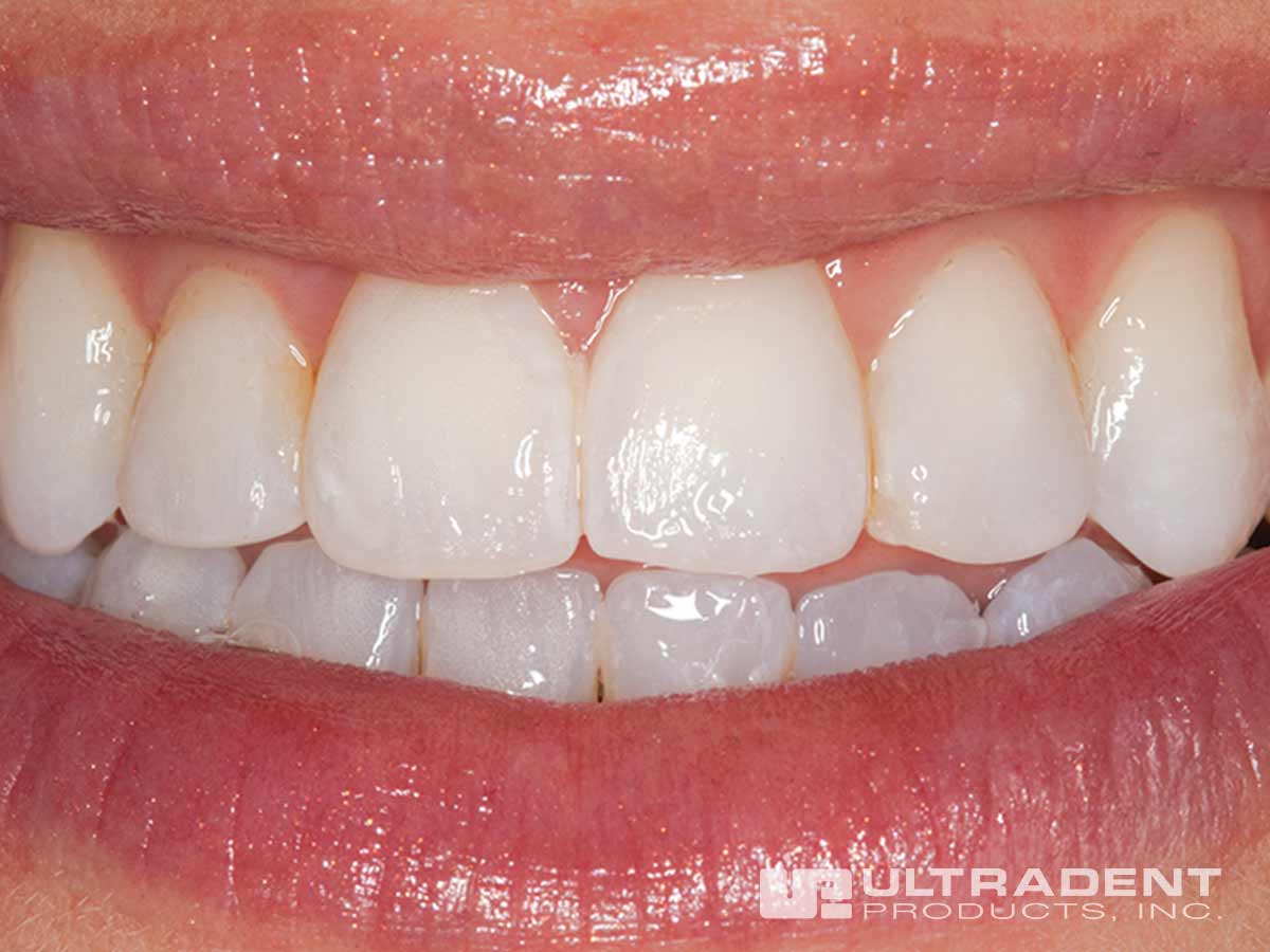 Enamelast Teeth After Application.jpg