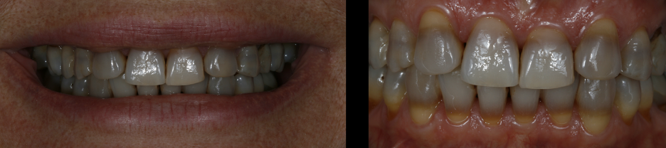 Patient’s initial severe tetracycline stained teeth.