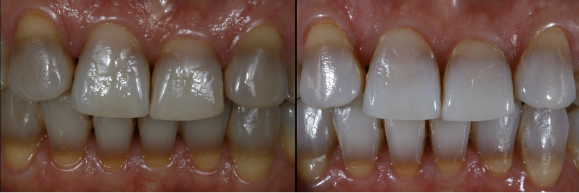 Results after the end of whitening treatments