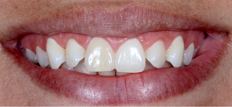 Patient presenting with left front tooth several shades darker than the other