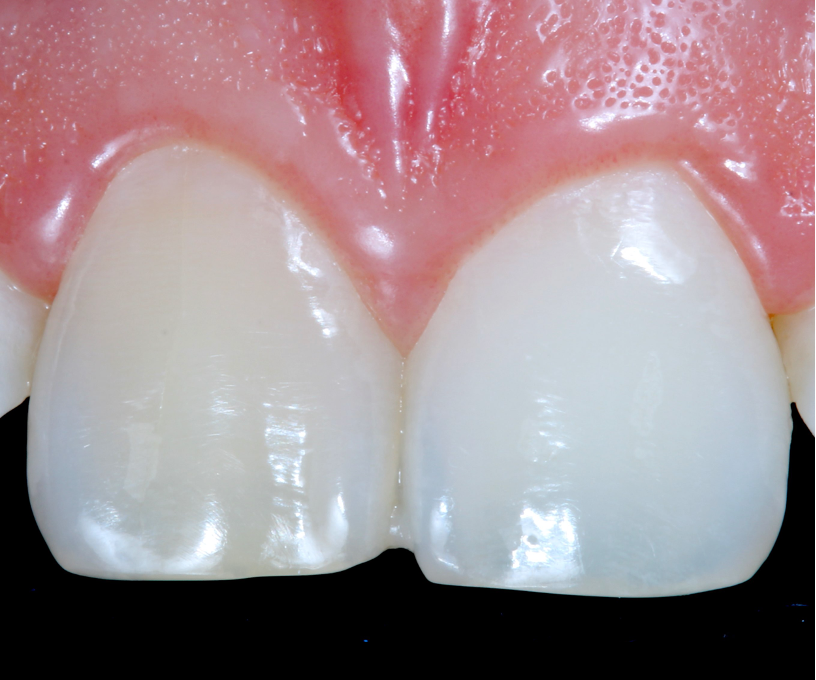 The darker tooth prior to treatment