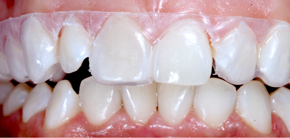 Pateint wearing custom tray to only apply to one tooth