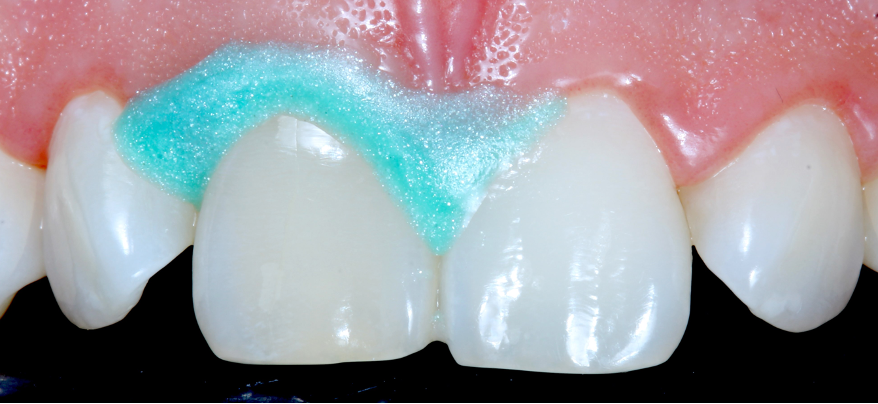 Applying Opalescence Boost in-office whitening to a single tooth.
