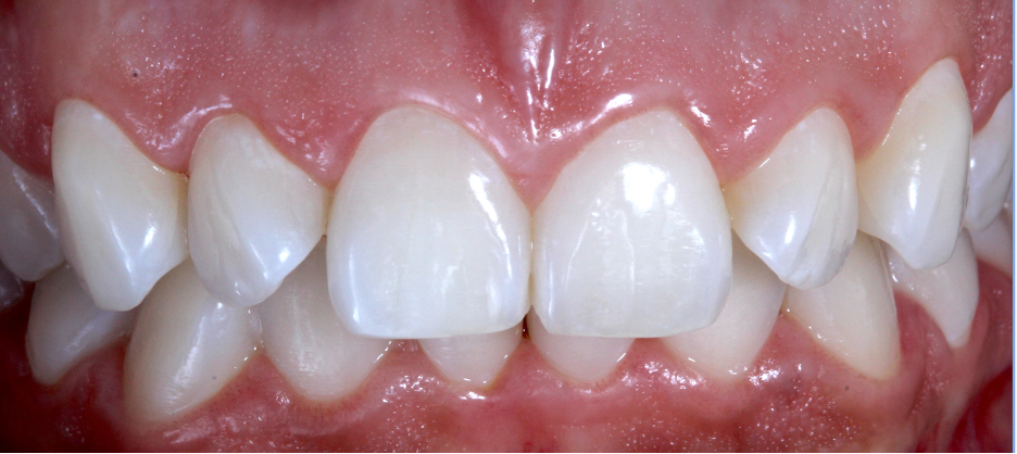 Final teeth whitening results