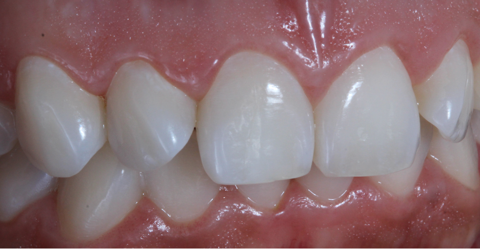 Final teeth whitening results