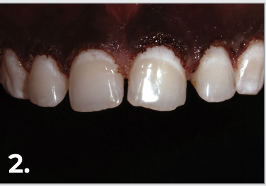 Dr. Jacobson performed a gingivectomy with the Gemini™ laser.